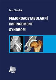 Femoroacetabulární impingement syndrom